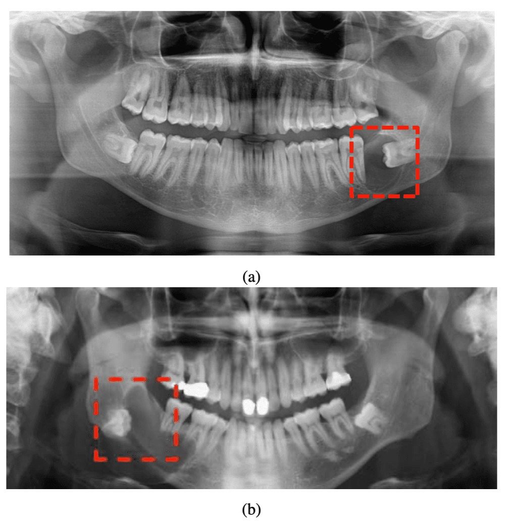 Dental panoramic radiography images showing dentigerous cysts